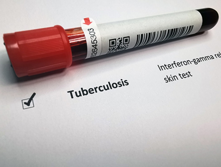 Tuberculosis lab test vial